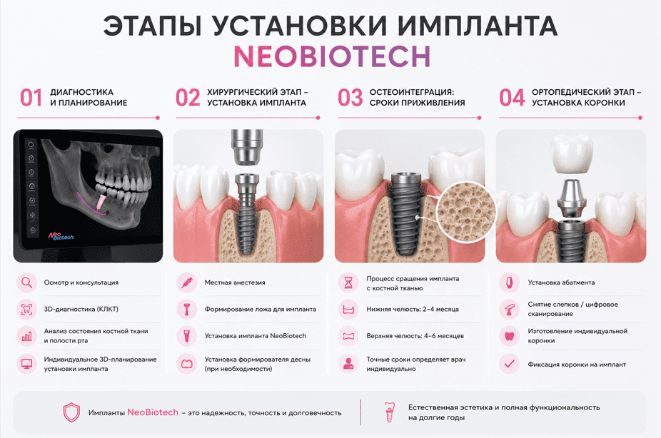 Этапы установки импланта NeoBiotech
