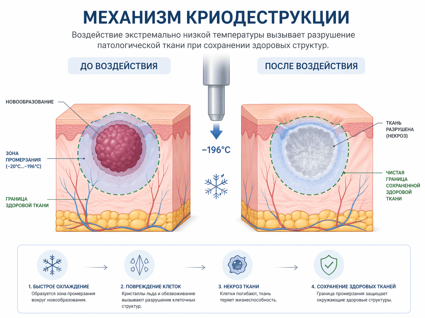 Механизм криодеструкции