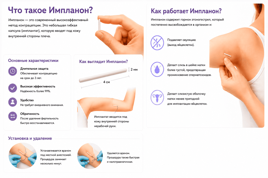Что такое Импланон и как он работает
